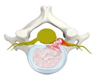 Cervical Disc Herniation