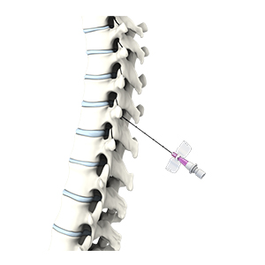 Cervical Epidural Cortisone Injections