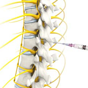 Epidural Steroid Injection