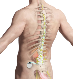 spinal-cord-stimulation