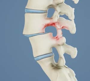 Spondylolysis