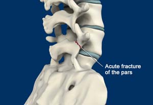 Spondylolisthesis